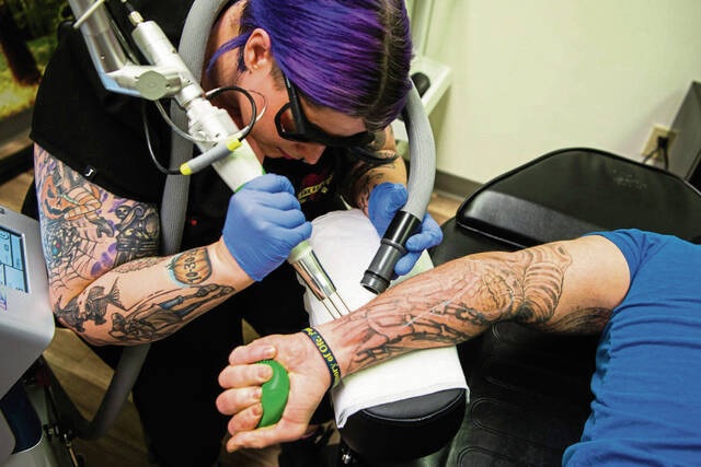 Second chance: Unwanted tattoos can be lasered off or covered up – Ink  Eraser Tattoo Removal Cranberry PA